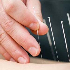 Acupunctura poate slabi? - Forumul Softpedia