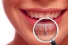 Cui i se adreseaza implantul dentar?